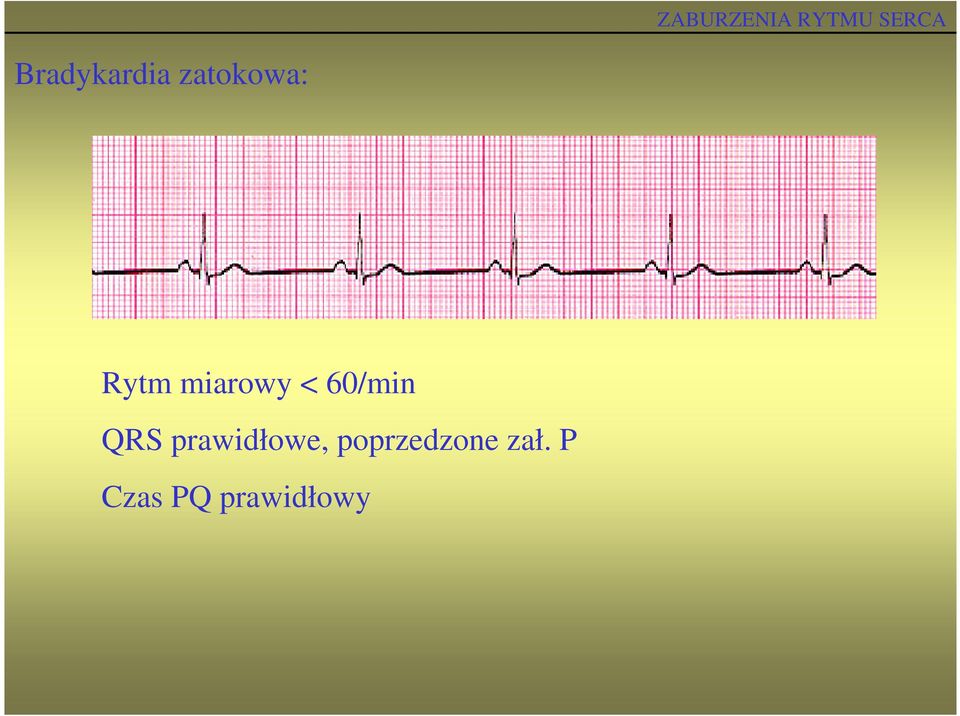 QRS prawidłowe,