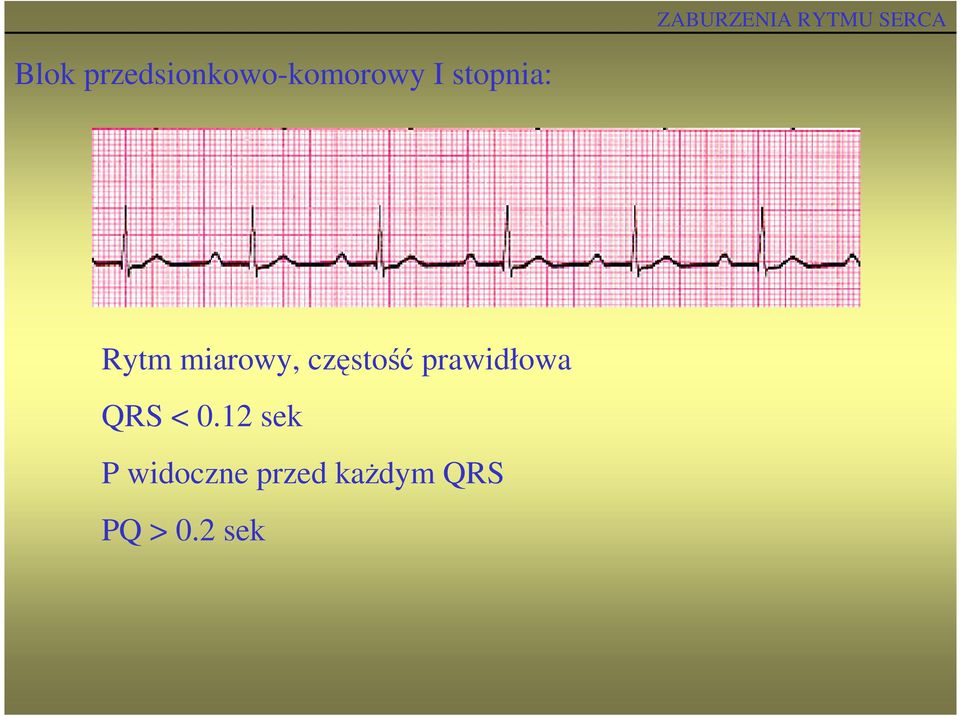 prawidłowa QRS < 0.