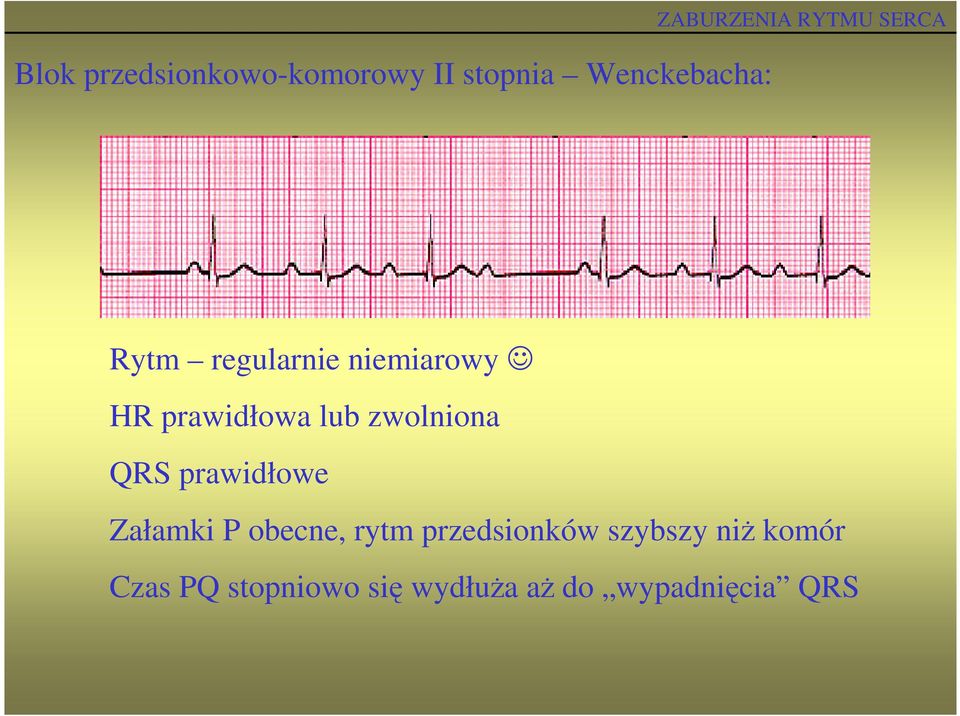 zwolniona QRS prawidłowe Załamki P obecne, rytm przedsionków