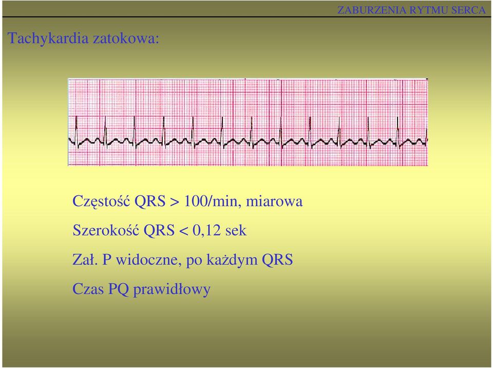 Szerokość QRS < 0,12 sek Zał.