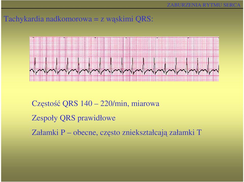 miarowa Zespoły QRS prawidłowe