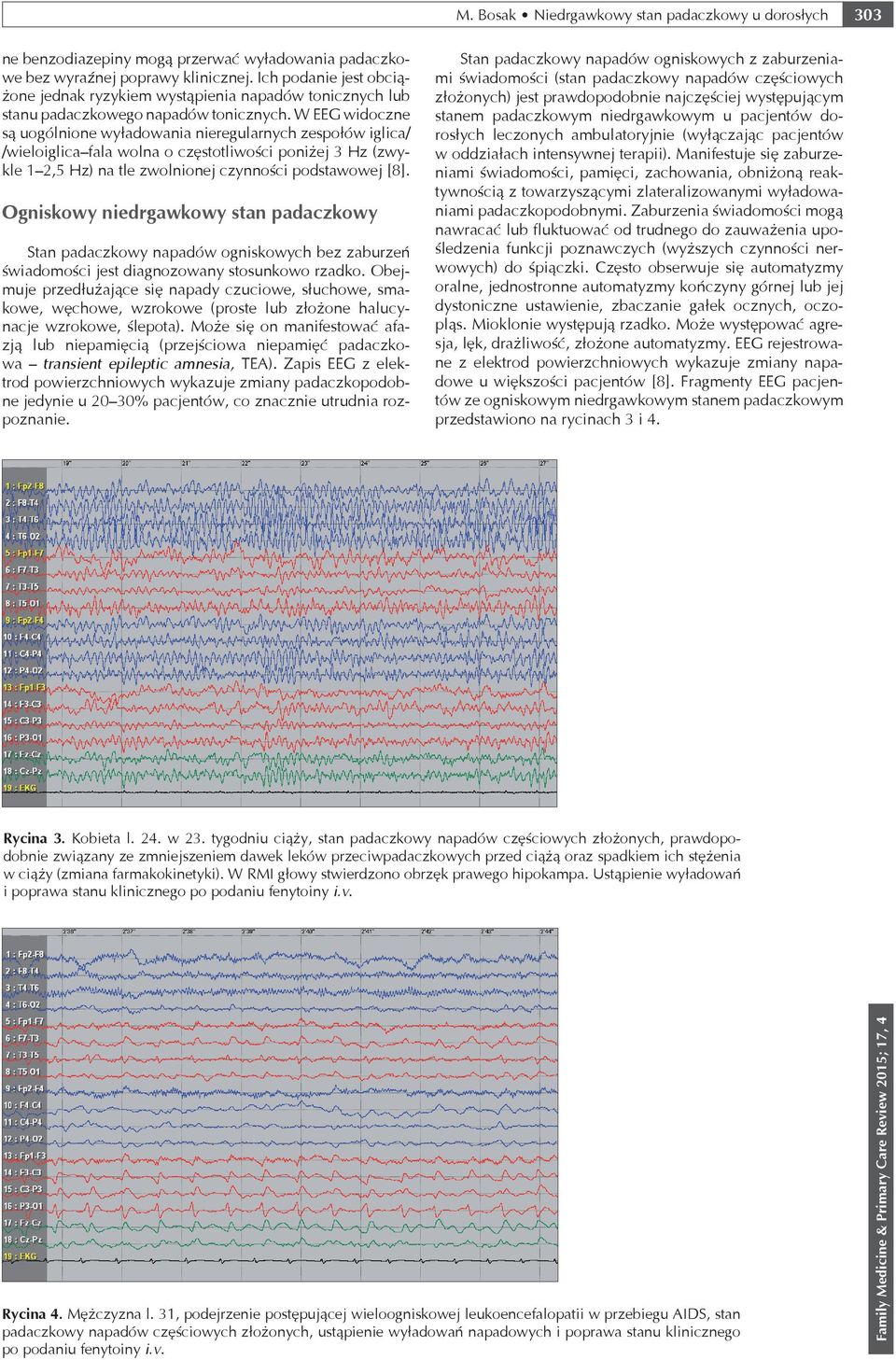 W EEG widoczne są uogólnione wyładowania nieregularnych zespołów iglica/ /wieloiglica fala wolna o częstotliwości poniżej 3 Hz (zwykle 1 2,5 Hz) na tle zwolnionej czynności podstawowej [8].