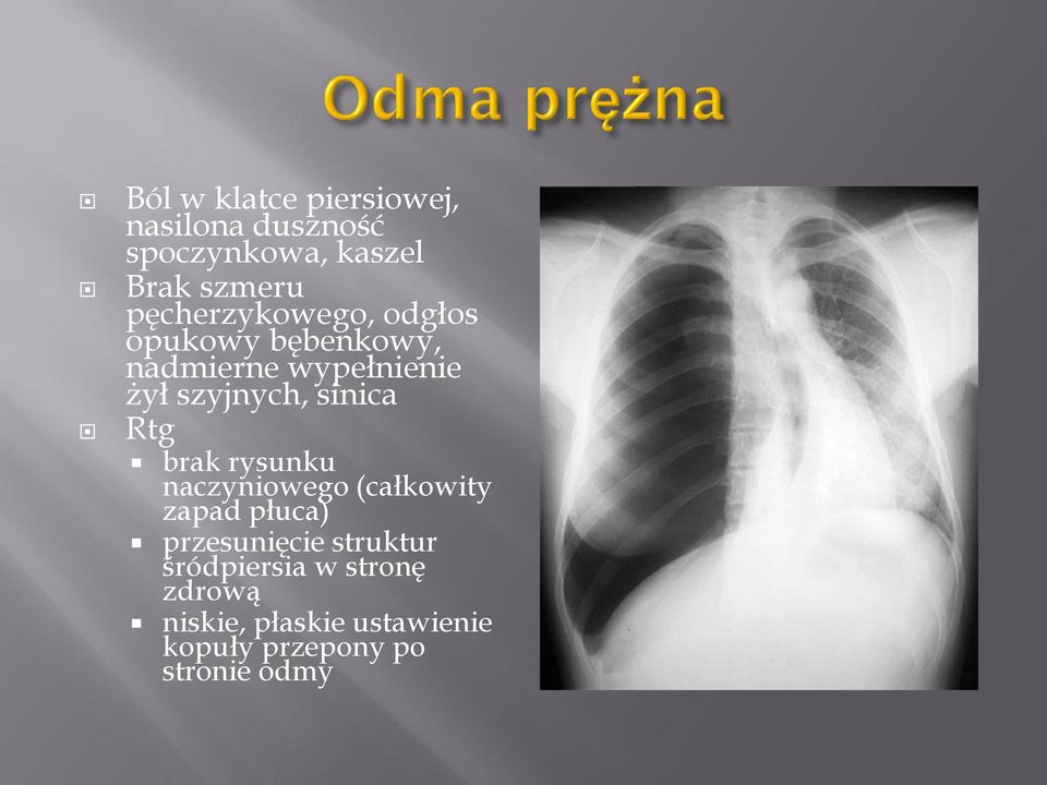 sinica Rtg brak rysunku naczyniowego (całkowity zapad płuca) przesunięcie