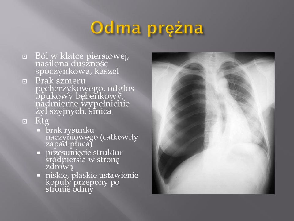 sinica Rtg brak rysunku naczyniowego (całkowity zapad płuca) przesunięcie