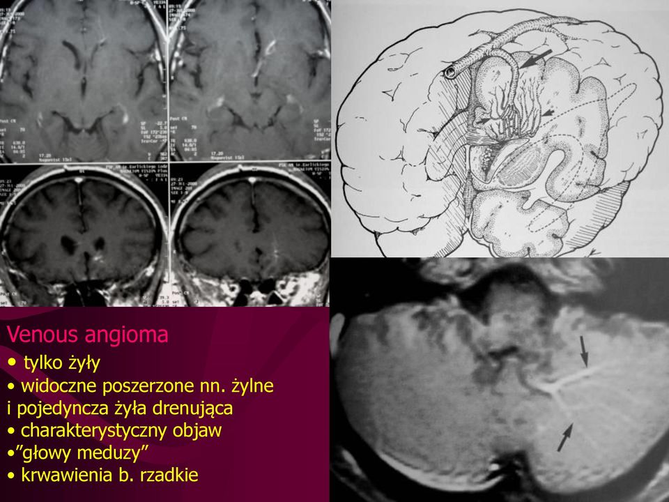 żylne i pojedyncza żyła drenująca