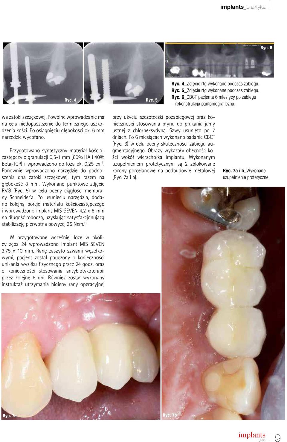 Przygotowano syntetyczny materiał kościozastępczy o granulacji 0,5-1 mm (60% HA i 40% Beta-TCP) i wprowadzono do łoża ok. 0,25 cm 3.