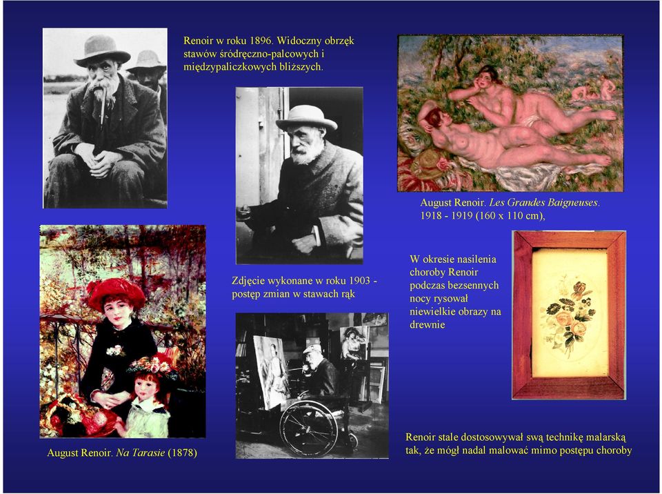 1918-1919 (160 x 110 cm), Zdjęcie wykonane w roku 1903 - postęp zmian w stawach rąk W okresie nasilenia