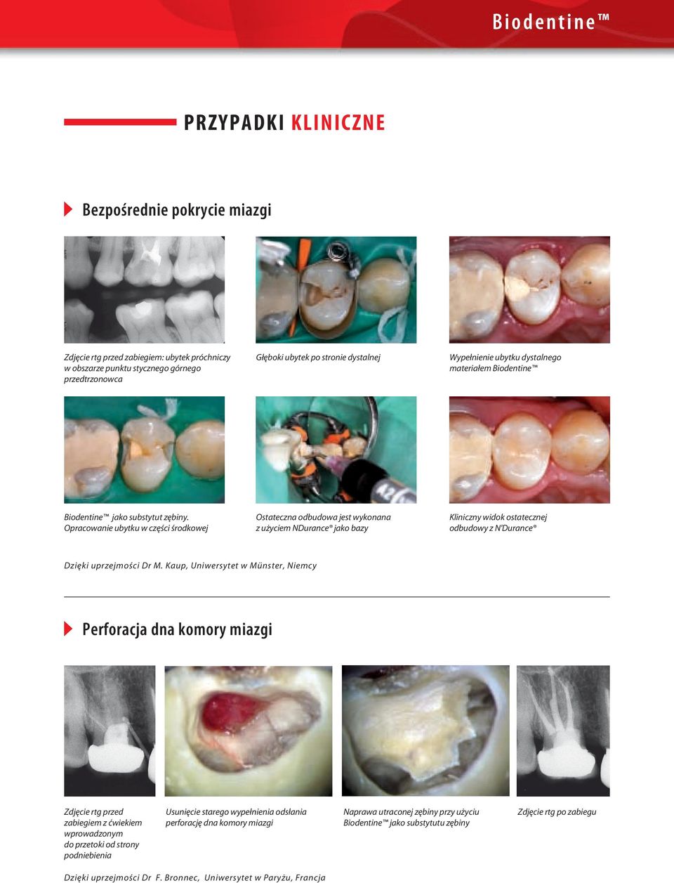 Opracowanie ubytku w części środkowej Ostateczna odbudowa jest wykonana z użyciem NDurance jako bazy Kliniczny widok ostatecznej odbudowy z N'Durance Dzięki uprzejmości Dr M.