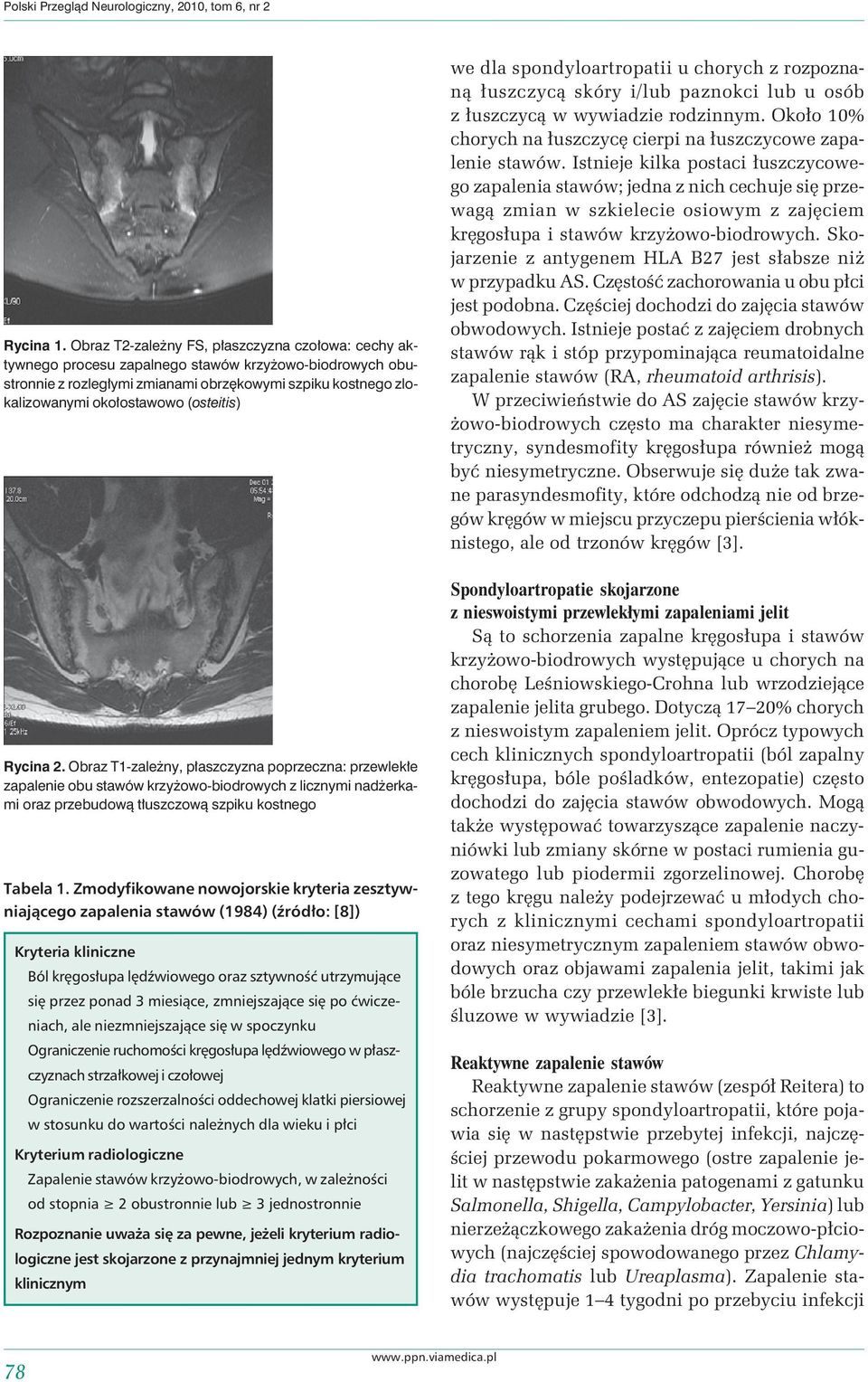 (osteitis) Rycina 2. Obraz T1-zależny, płaszczyzna poprzeczna: przewlekłe zapalenie obu stawów krzyżowo-biodrowych z licznymi nadżerkami oraz przebudową tłuszczową szpiku kostnego Tabela 1.
