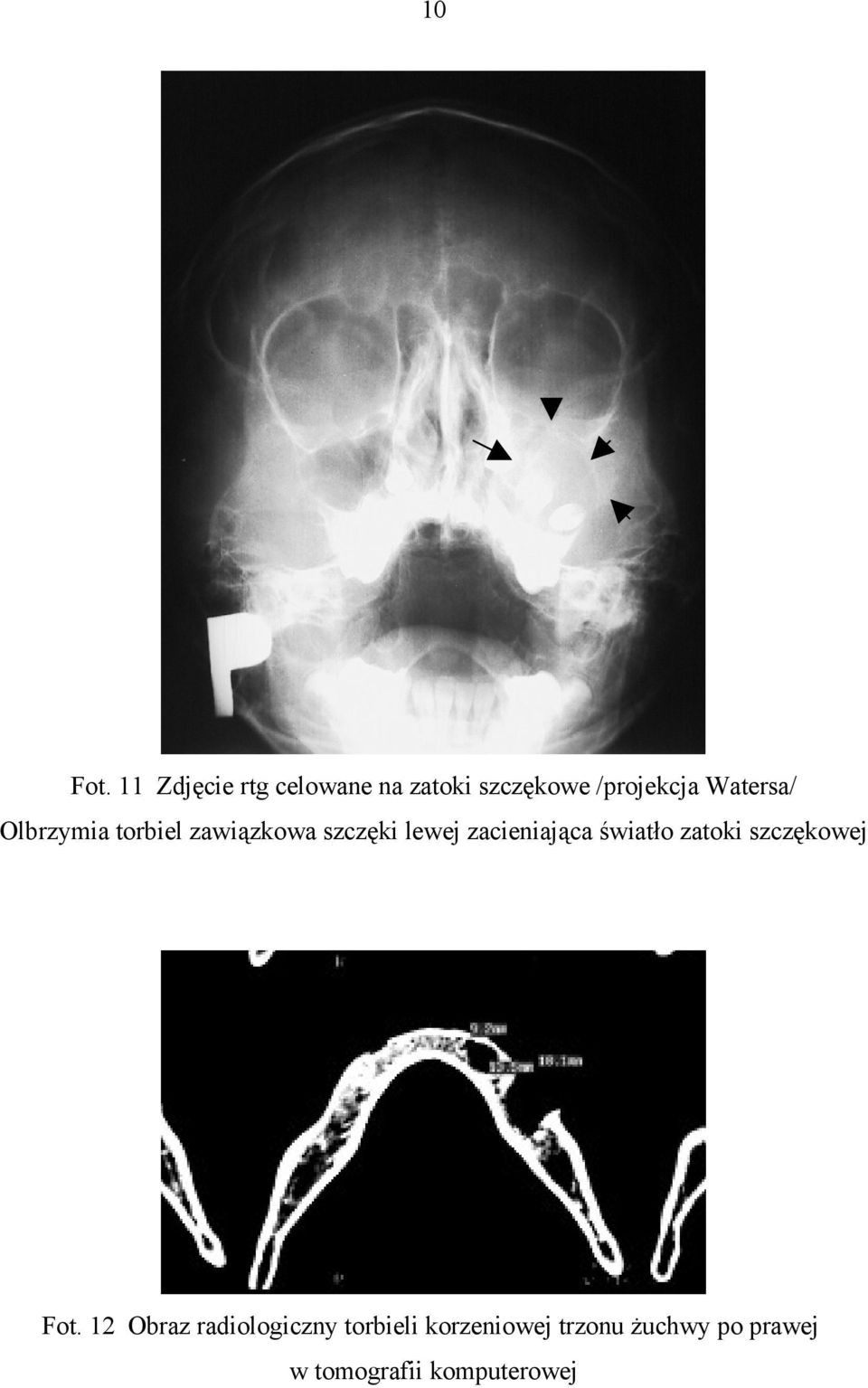 Watersa/ Olbrzymia torbiel zawiązkowa szczęki lewej