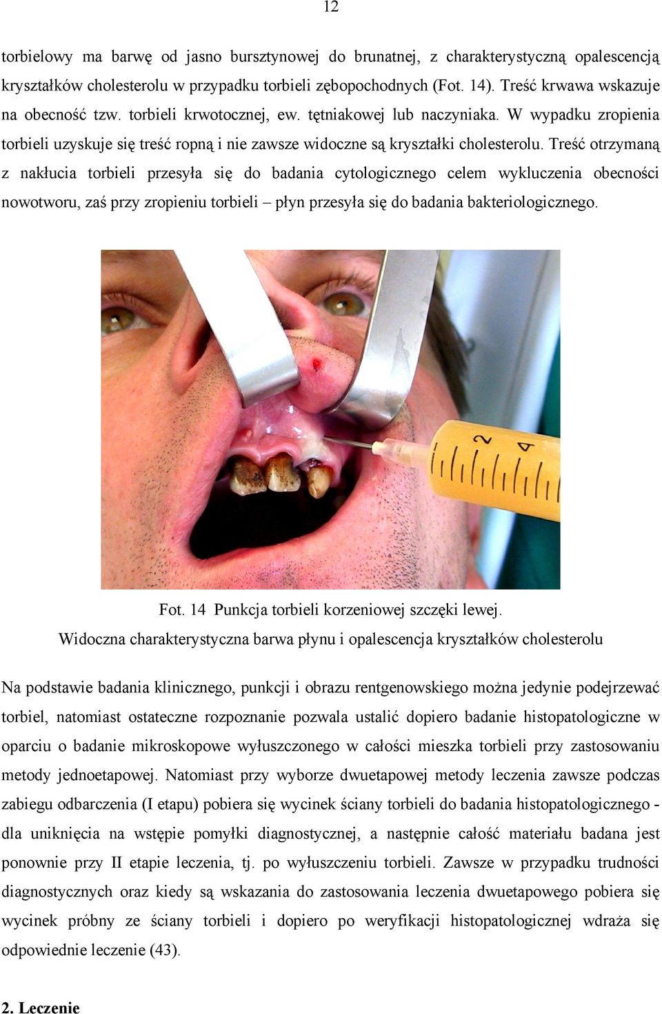 Treść otrzymaną z nakłucia torbieli przesyła się do badania cytologicznego celem wykluczenia obecności nowotworu, zaś przy zropieniu torbieli płyn przesyła się do badania bakteriologicznego. Fot.