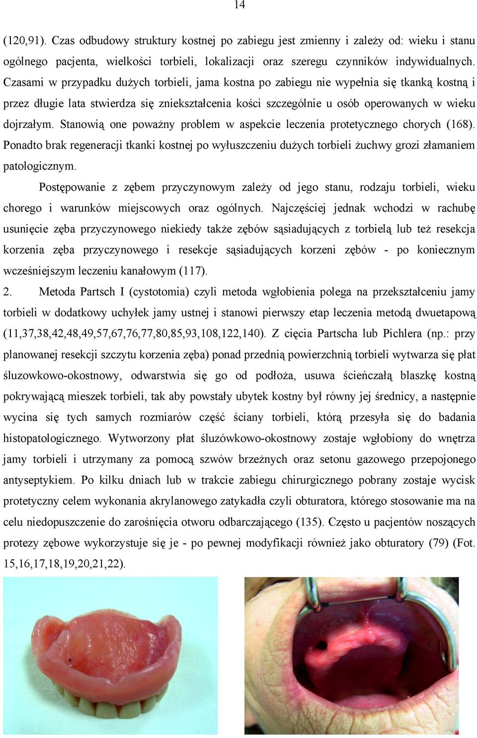 Stanowią one poważny problem w aspekcie leczenia protetycznego chorych (168). Ponadto brak regeneracji tkanki kostnej po wyłuszczeniu dużych torbieli żuchwy grozi złamaniem patologicznym.