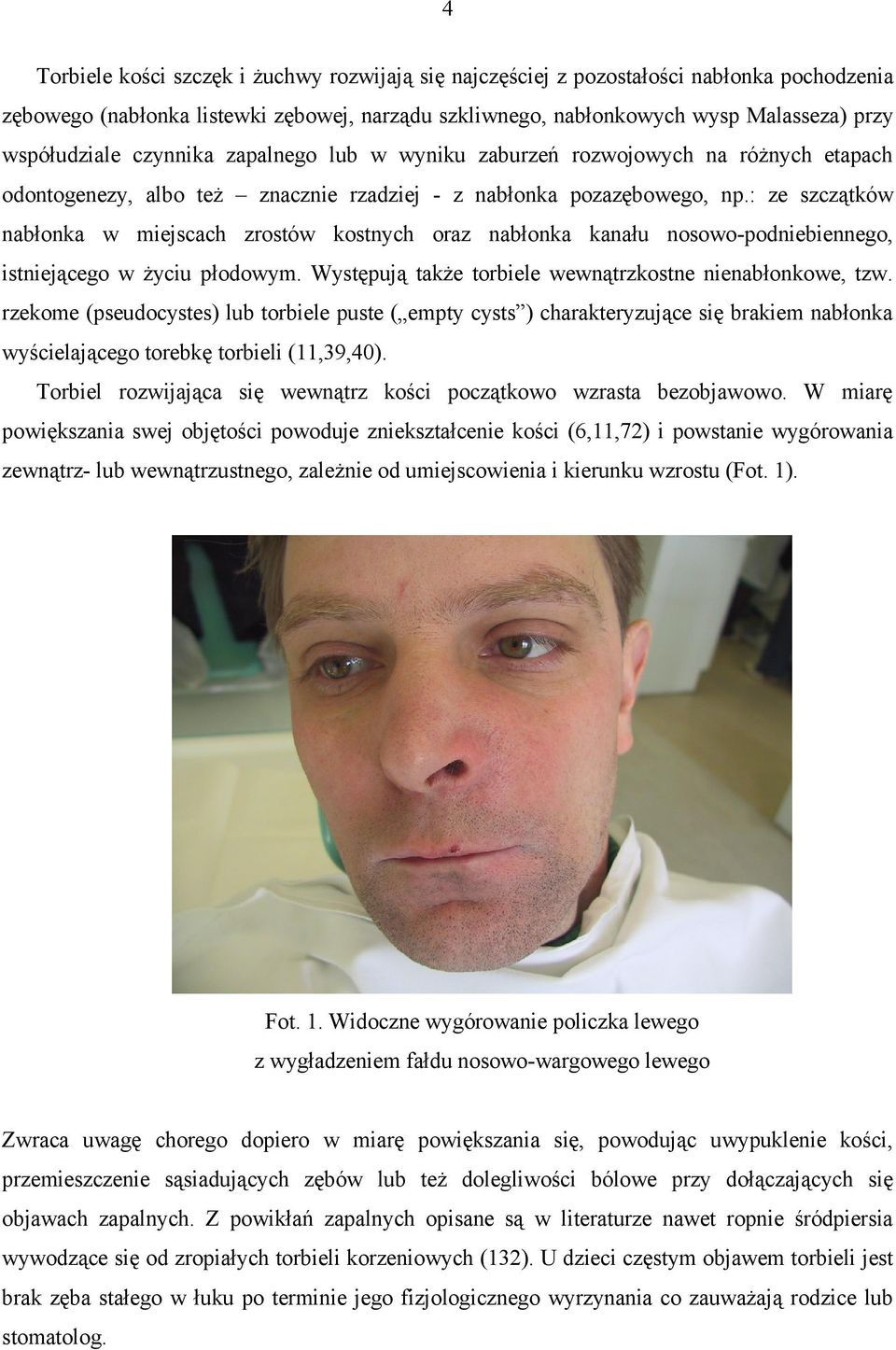: ze szczątków nabłonka w miejscach zrostów kostnych oraz nabłonka kanału nosowo-podniebiennego, istniejącego w życiu płodowym. Występują także torbiele wewnątrzkostne nienabłonkowe, tzw.