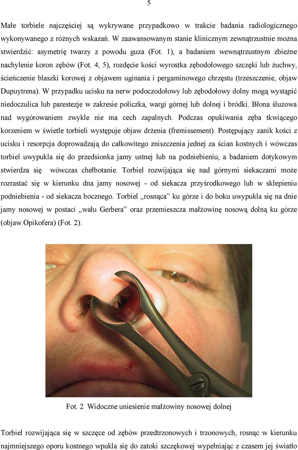 4, 5), rozdęcie kości wyrostka zębodołowego szczęki lub żuchwy, ścieńczenie blaszki korowej z objawem uginania i pergaminowego chrzęstu (trzeszczenie, objaw Dupuytrena).