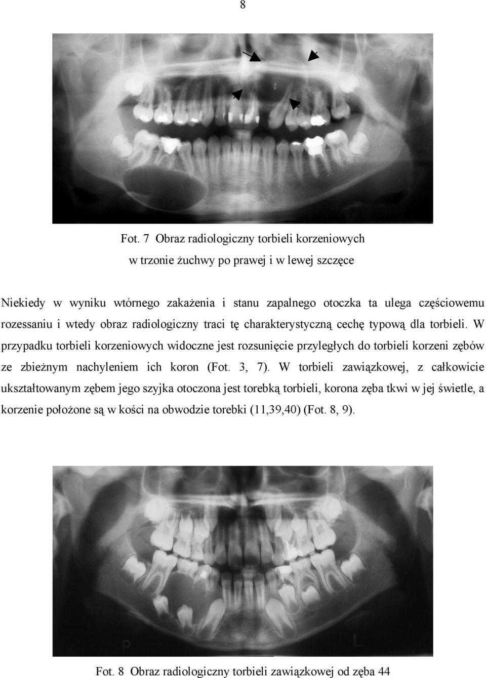 częściowemu rozessaniu i wtedy obraz radiologiczny traci tę charakterystyczną cechę typową dla torbieli.