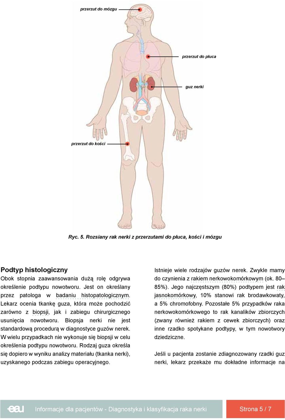 Jest on określany przez patologa w badaniu histopatologicznym. Lekarz ocenia tkankę guza, która może pochodzić zarówno z biopsji, jak i zabiegu chirurgicznego usunięcia nowotworu.