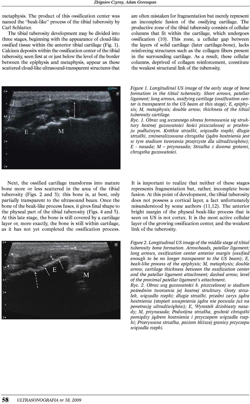 calcium deposits within the ossification center of the tibial tuberosity, seen first at or just below the level of the border between the epiphysis and metaphysis, appear as these scattered