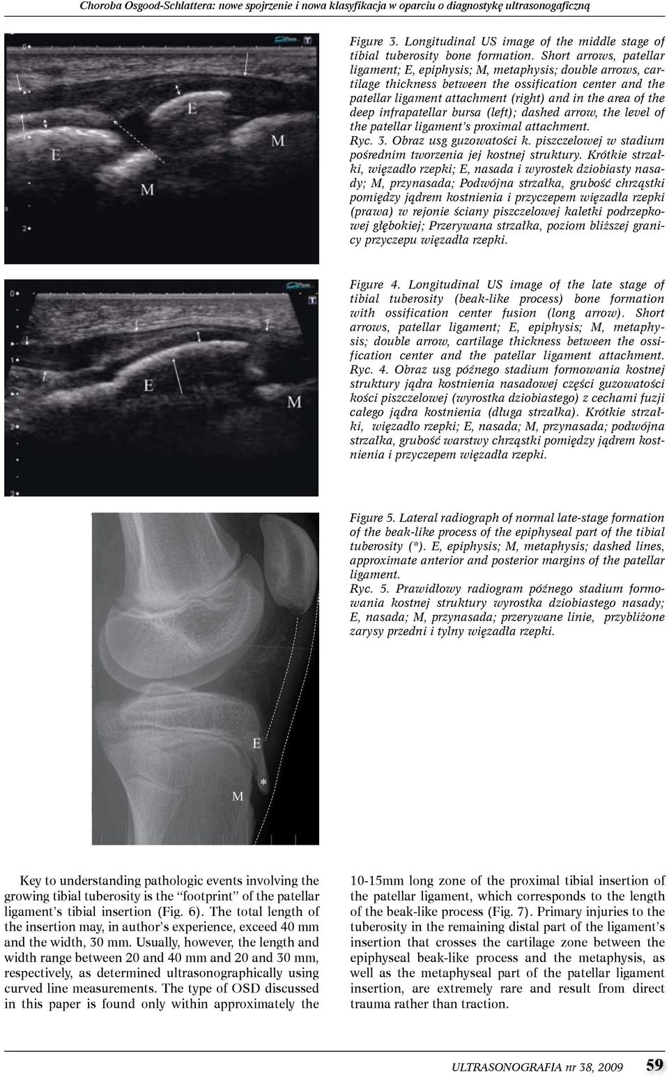 deep infrapatellar bursa (left); dashed arrow, the level of the patellar ligament s proximal attachment. Ryc. 3. Obraz usg guzowatości k.