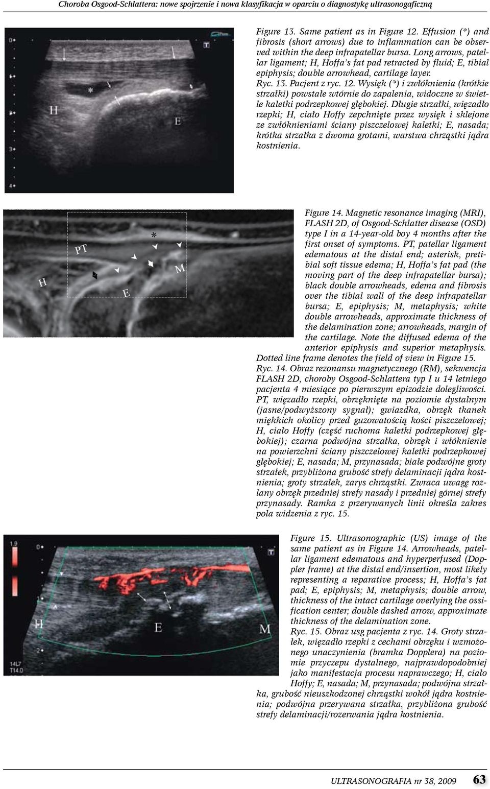 Long arrows, patellar ligament; H, Hoffa s fat pad retracted by fluid; E, tibial epiphysis; double arrowhead, cartilage layer. Ryc. 13. Pacjent z ryc. 12.
