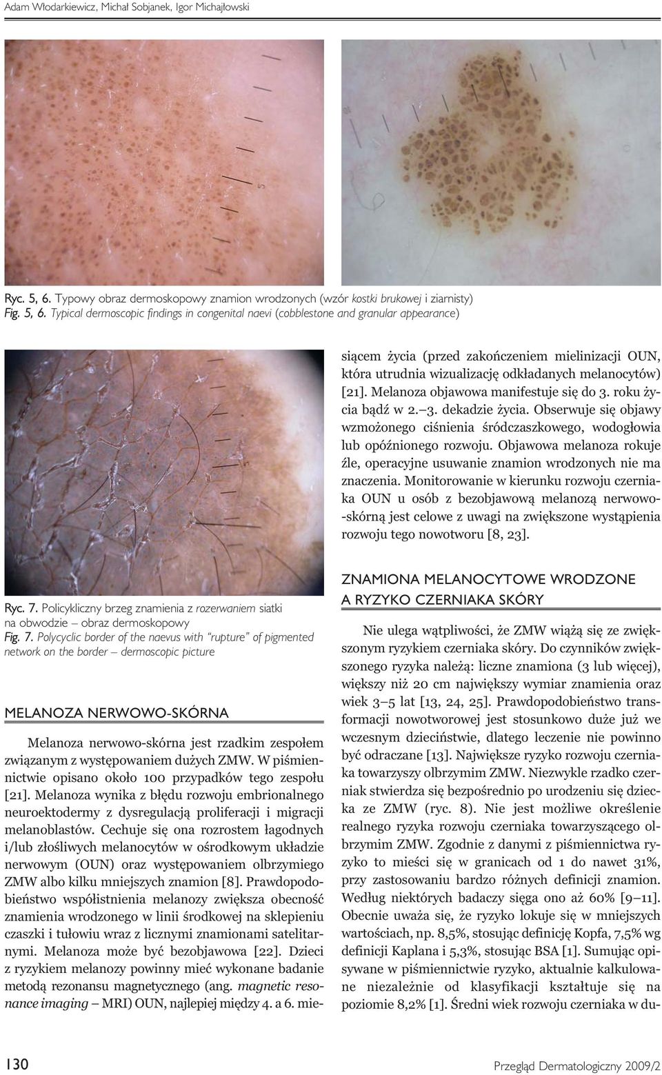 Typical dermoscopic findings in congenital naevi (cobblestone and granular appearance) Melanoza nerwowo-skórna jest rzadkim zespołem związanym z występowaniem dużych ZMW.