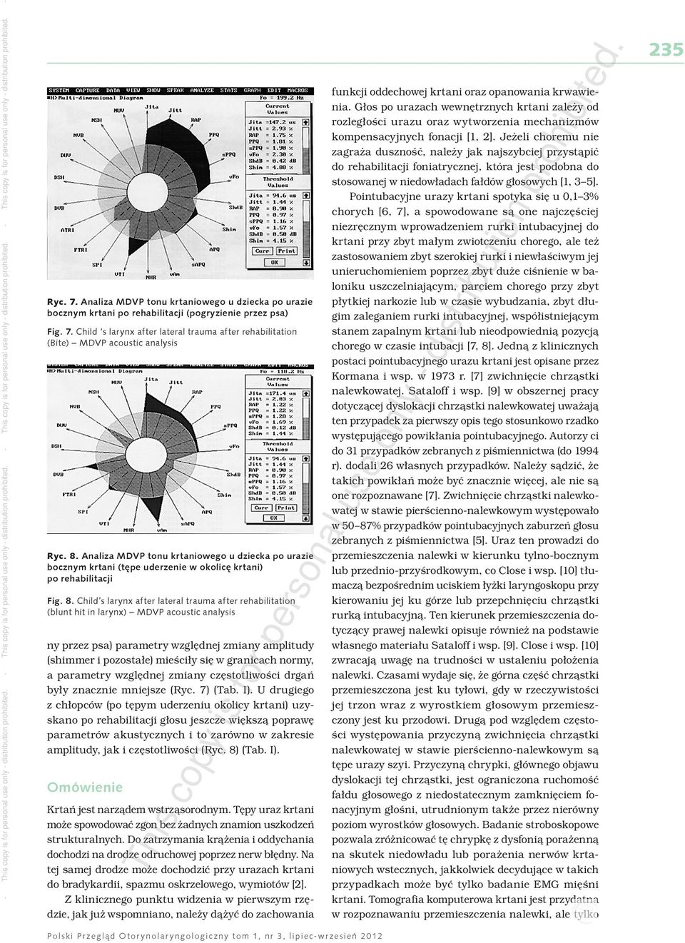 Child s larynx after lateral trauma after rehabilitation (blunt hit in larynx) MDVP acoustic analysis ny przez psa) parametry względnej zmiany amplitudy (shimmer i pozostałe) mieściły się w granicach
