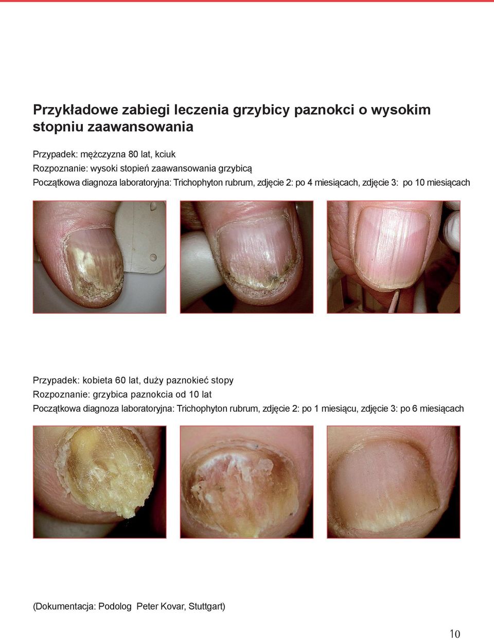 3: po 10 miesiącach Przypadek: kobieta 60 lat, duży paznokieć stopy Rozpoznanie: grzybica paznokcia od 10 lat Początkowa diagnoza
