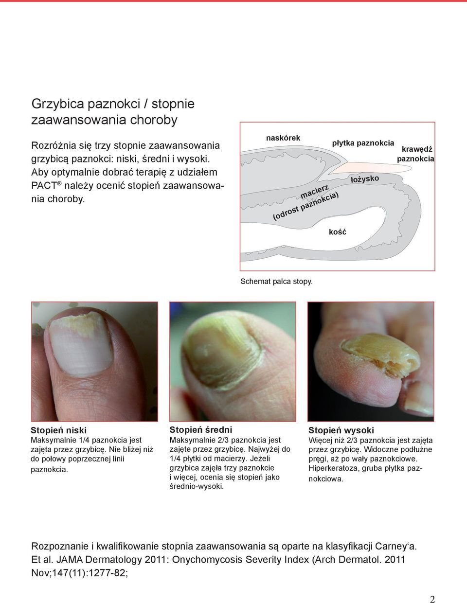 Stopień niski Maksymalnie 1/4 paznokcia jest zajęta przez grzybicę. Nie bliżej niż do połowy poprzecznej linii paznokcia. Stopień średni Maksymalnie 2/3 paznokcia jest zajęte przez grzybicę.