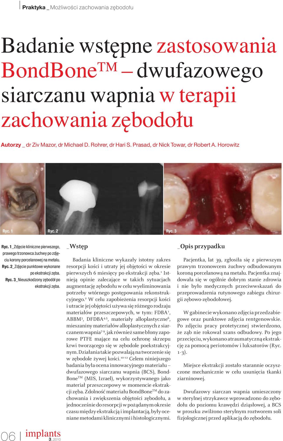 Ryc. 3_Nieuszkodzony z bodół po ekstrakcji z ba. 06 _Wstęp Badania kliniczne wykazały istotny zakres resorpcji kości i utraty jej objętości w okresie pierwszych 6 miesięcy po ekstrakcji zęba.