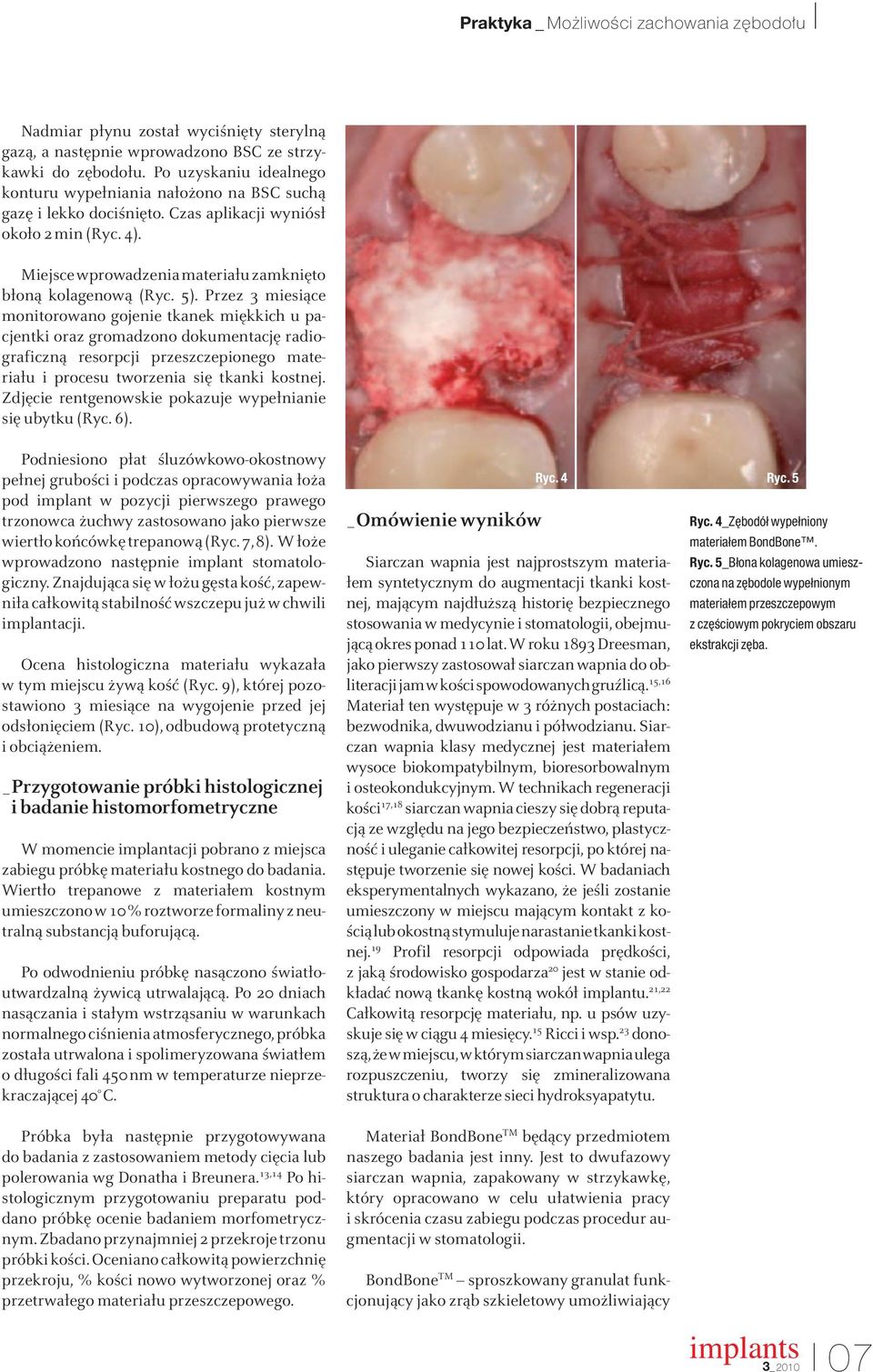 5). Przez 3 miesiące monitorowano gojenie tkanek miękkich u pacjentki oraz gromadzono dokumentację radiograficzną resorpcji przeszczepionego materiału i procesu tworzenia się tkanki kostnej.