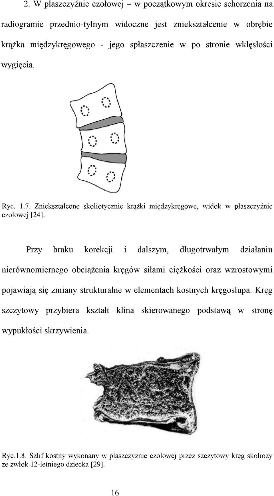Przy braku korekcji i dalszym, długotrwałym działaniu nierównomiernego obciążenia kręgów siłami ciężkości oraz wzrostowymi pojawiają się zmiany strukturalne w elementach