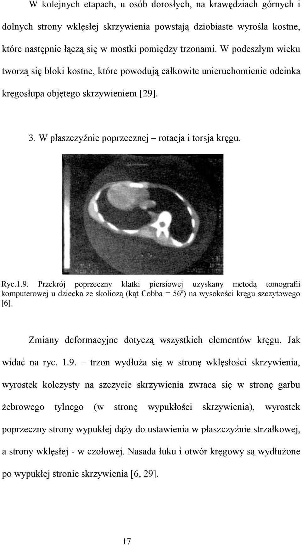 . 3. W płaszczyźnie poprzecznej rotacja i torsja kręgu. Ryc.1.9.