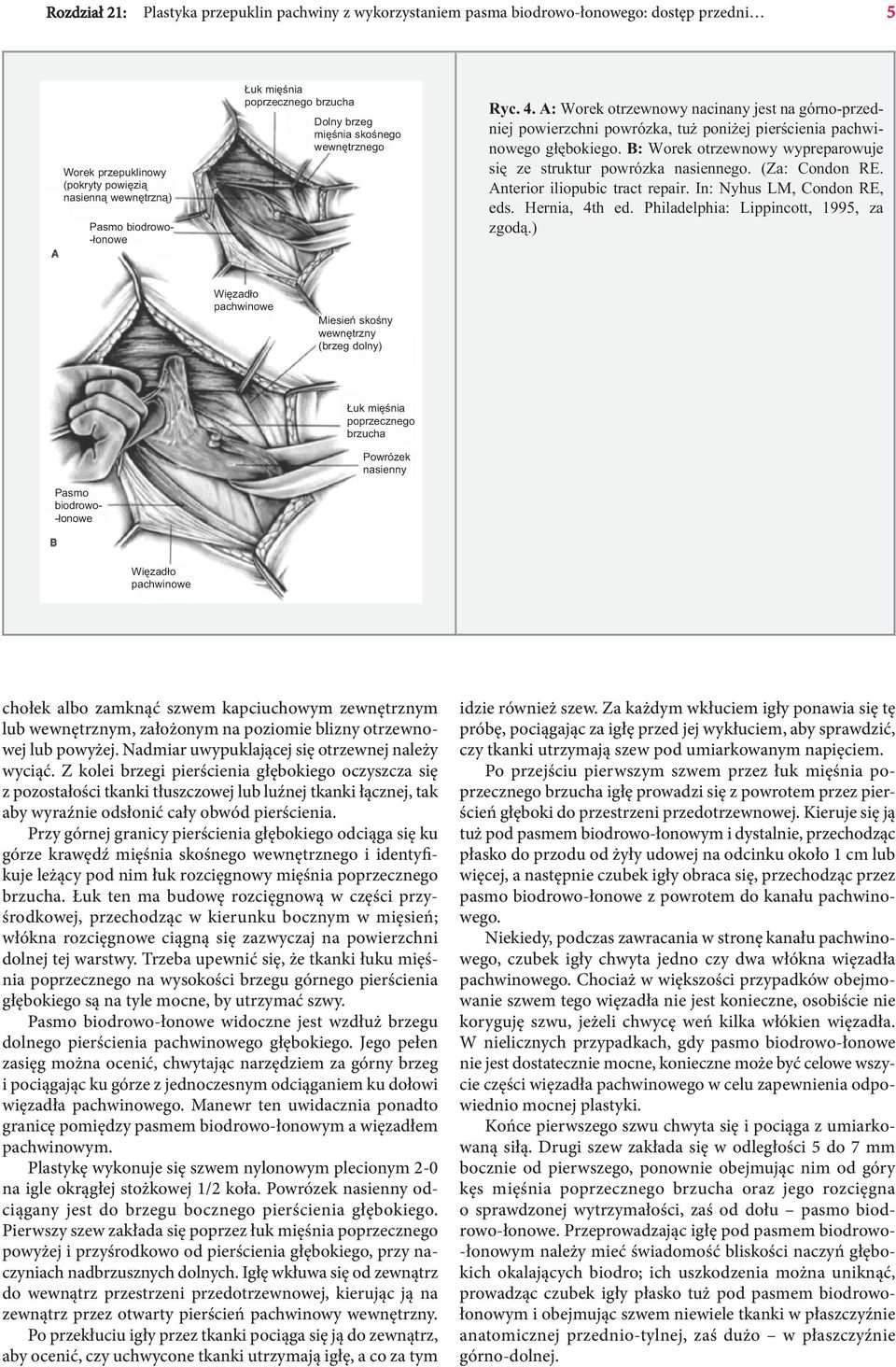 B: Worek otrzewnowy wypreparowuje się ze struktur powrózka nasiennego. (Za: Condon RE. Anterior iliopubic tract repair. In: Nyhus LM, Condon RE, eds. Hernia, 4th ed.