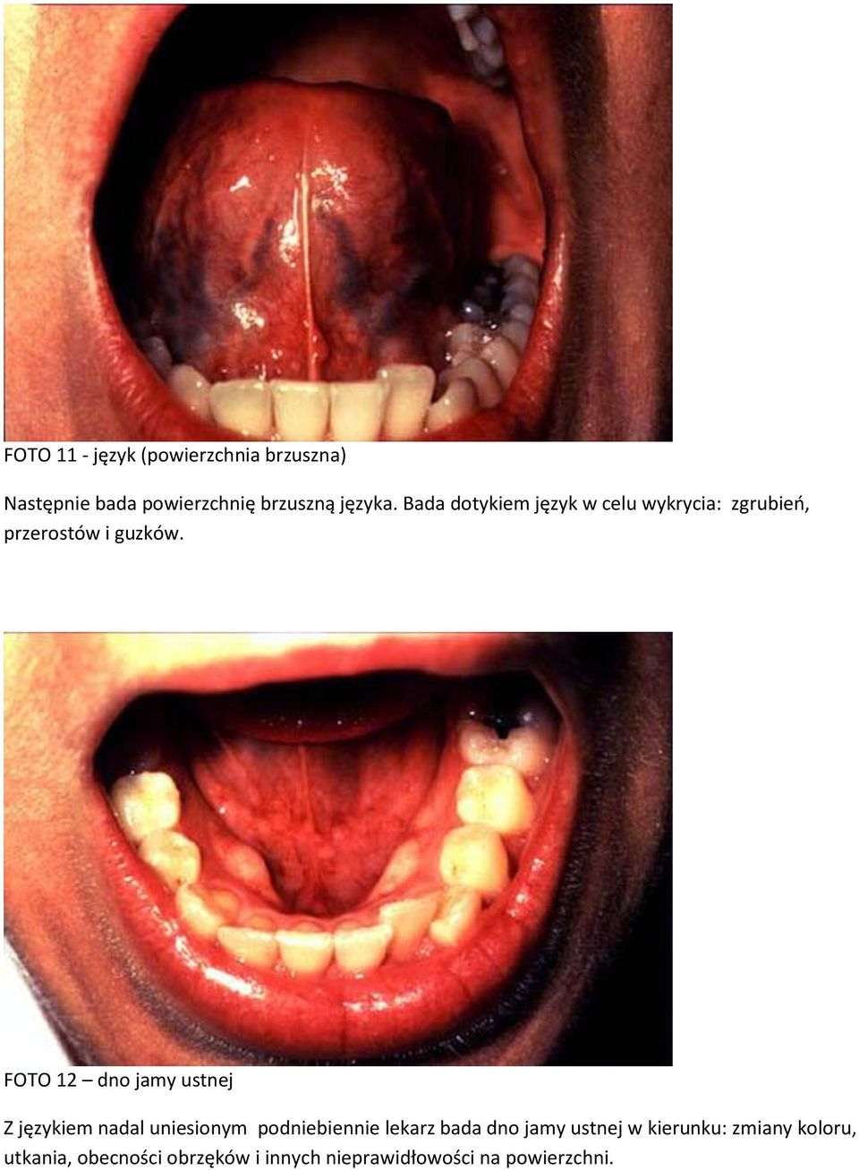 FOTO 12 dno jamy ustnej Z językiem nadal uniesionym podniebiennie lekarz bada dno