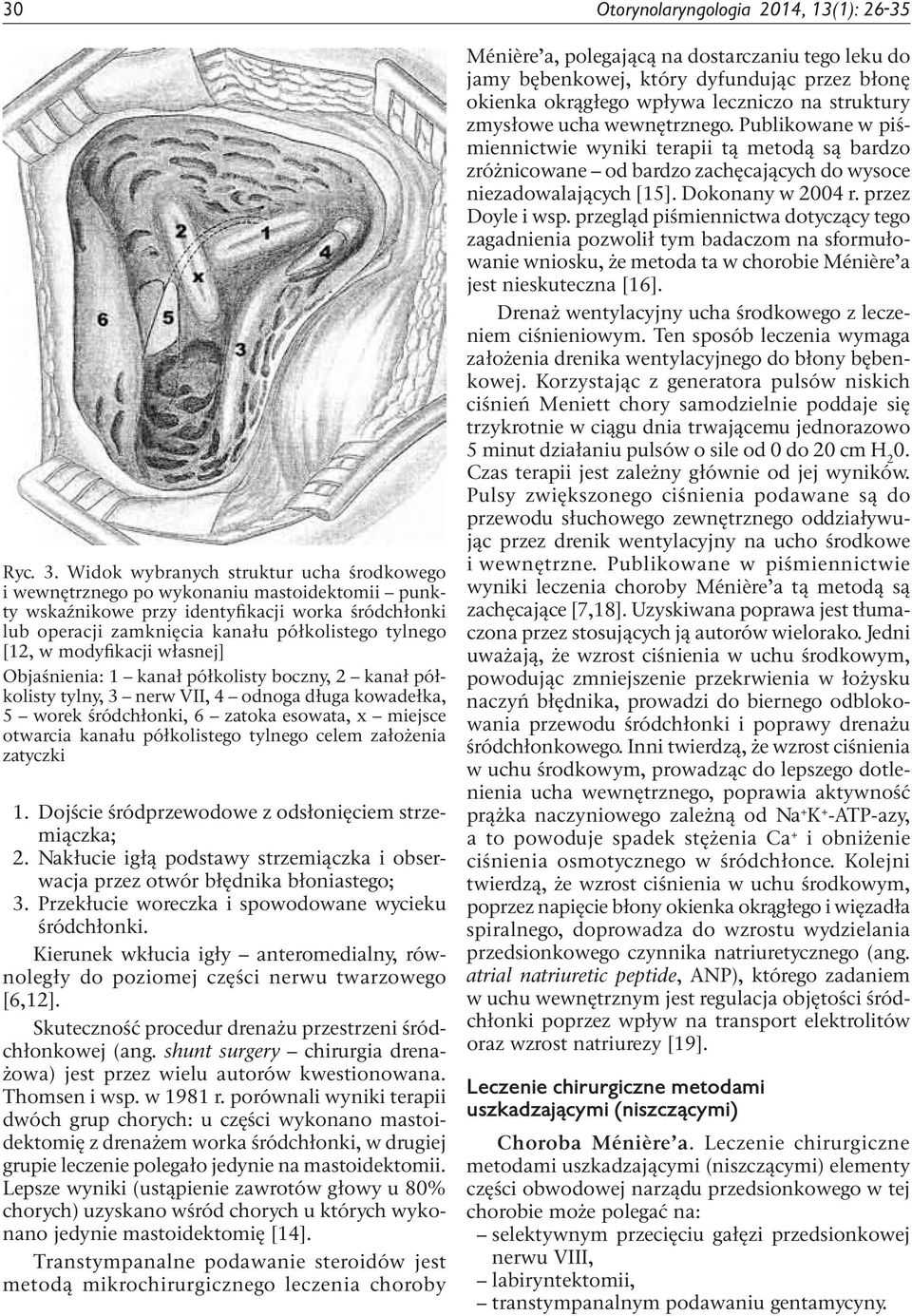 modyfikacji własnej] Objaśnienia: 1 kanał półkolisty boczny, 2 kanał półkolisty tylny, 3 nerw VII, 4 odnoga długa kowadełka, 5 worek śródchłonki, 6 zatoka esowata, x miejsce otwarcia kanału