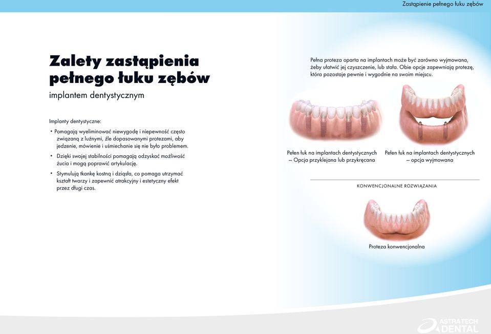 Implanty dentystyczne: Pomagają wyeliminować niewygodę i niepewność często związaną z luźnymi, źle dopasowanymi protezami, aby jedzenie, mówienie i uśmiechanie się nie było problemem.