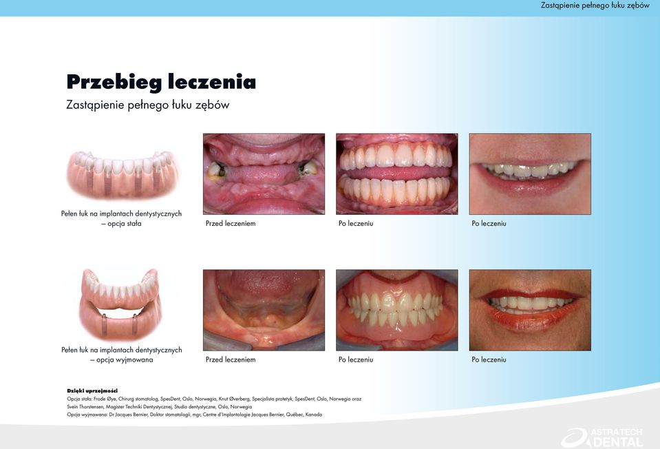 Øye, Chirurg stomatolog, SpesDent, Oslo, Norwegia, Knut Øverberg, Specjalista protetyk, SpesDent, Oslo, Norwegia oraz Svein Thorstensen, Magister Techniki