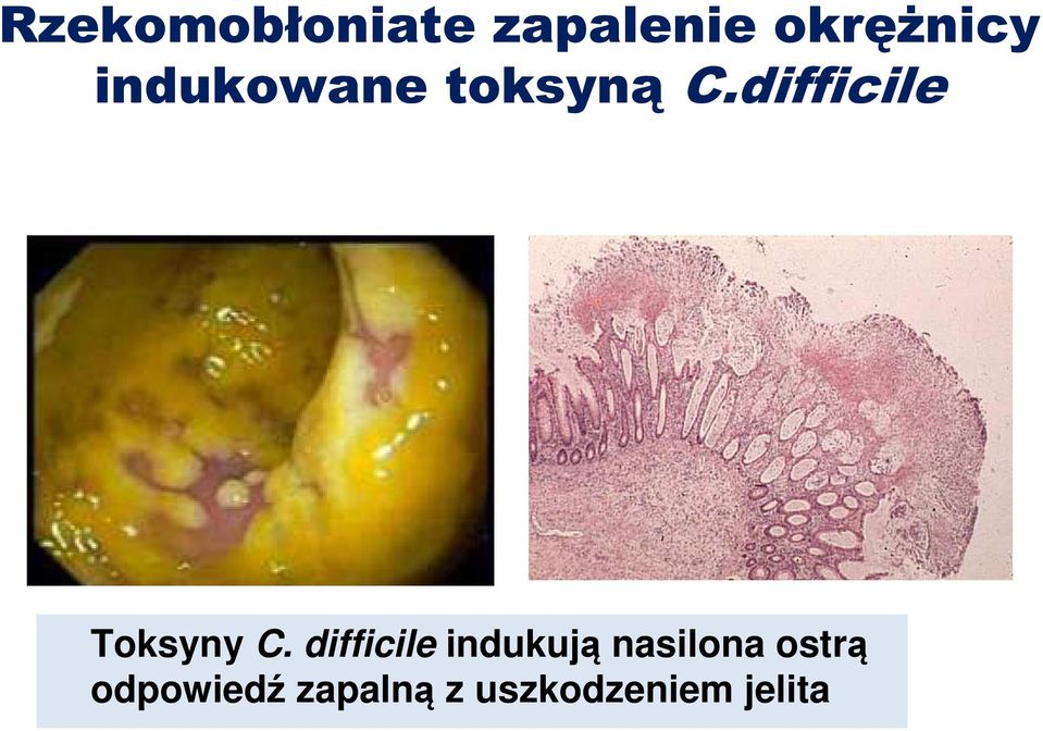 difficile Toksyny C.