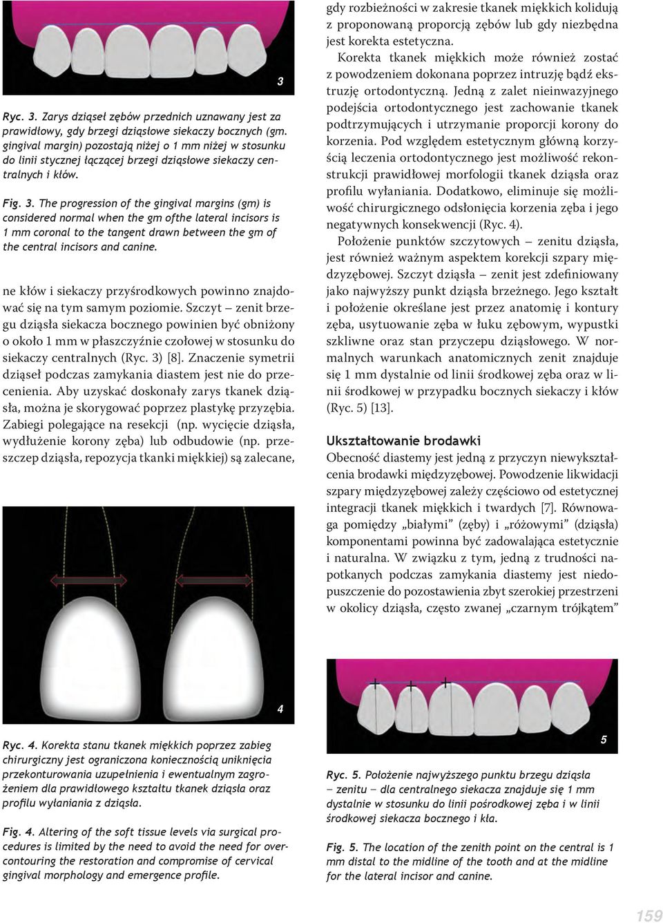 The progression of the gingival margins (gm) is considered normal when the gm ofthe lateral incisors is 1 mm coronal to the tangent drawn between the gm of the central incisors and canine.
