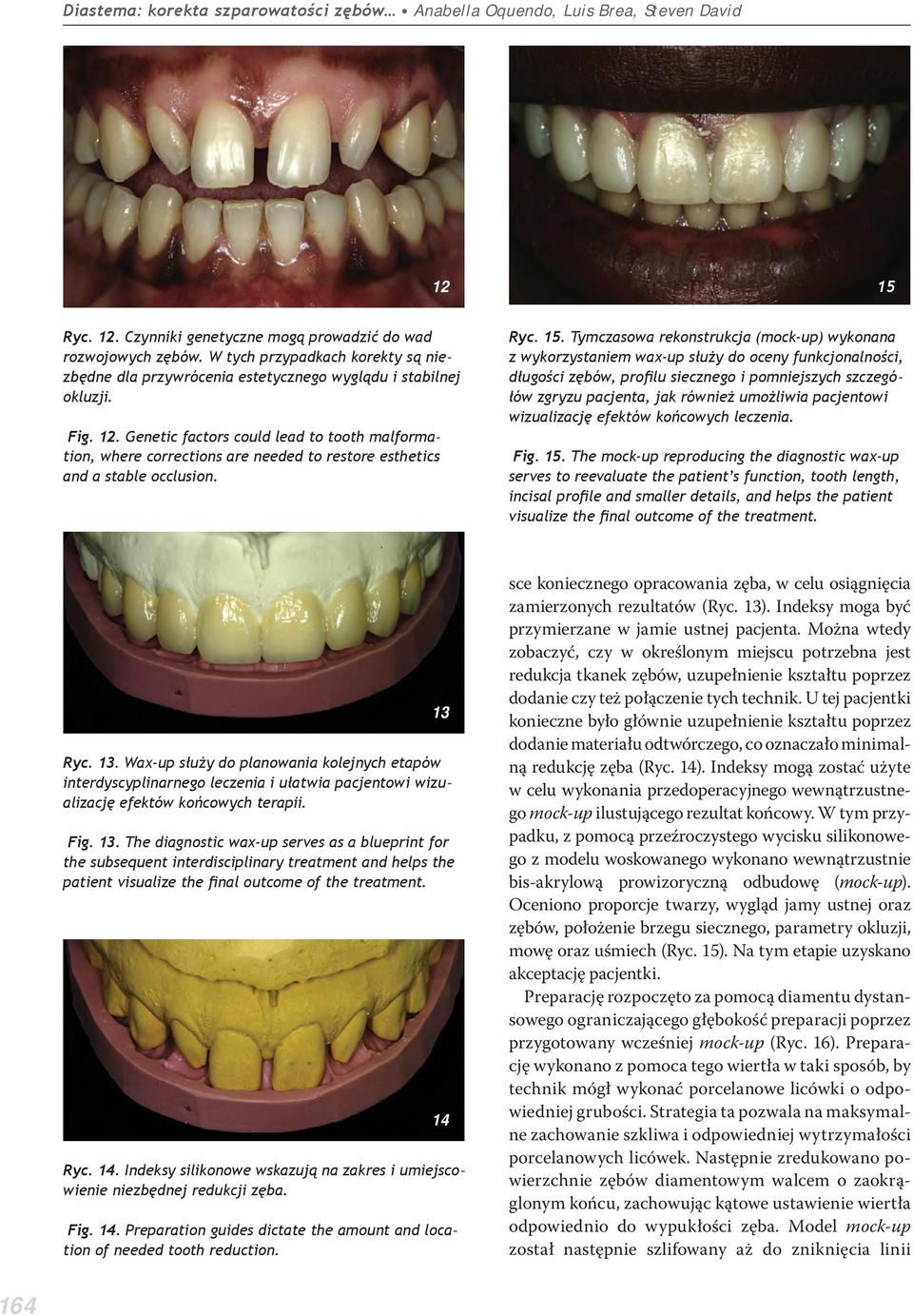 Genetic factors could lead to tooth malformation, where corrections are needed to restore esthetics and a stable occlusion. Ryc. 15.