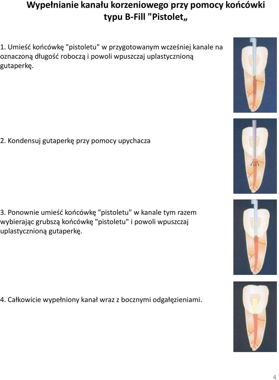 uplastycznioną gutaperkę. 2. Kondensuj gutaperkę przy pomocy upychacza 3.