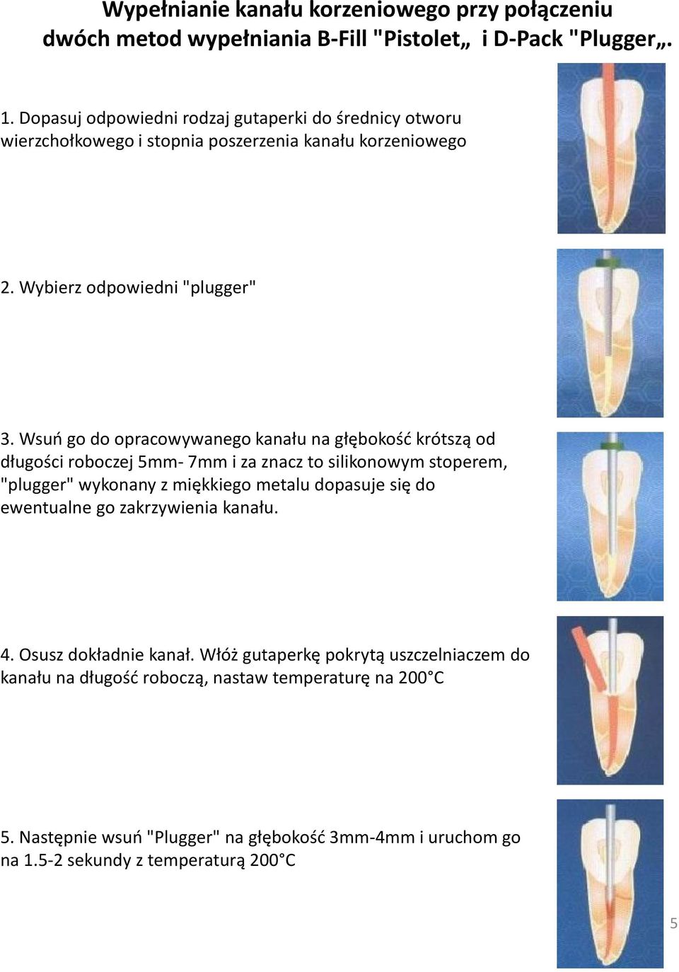 Wsuń go do opracowywanego kanału na głębokość krótszą od długości roboczej 5mm- 7mm i za znacz to silikonowym stoperem, "plugger" wykonany z miękkiego metalu dopasuje się