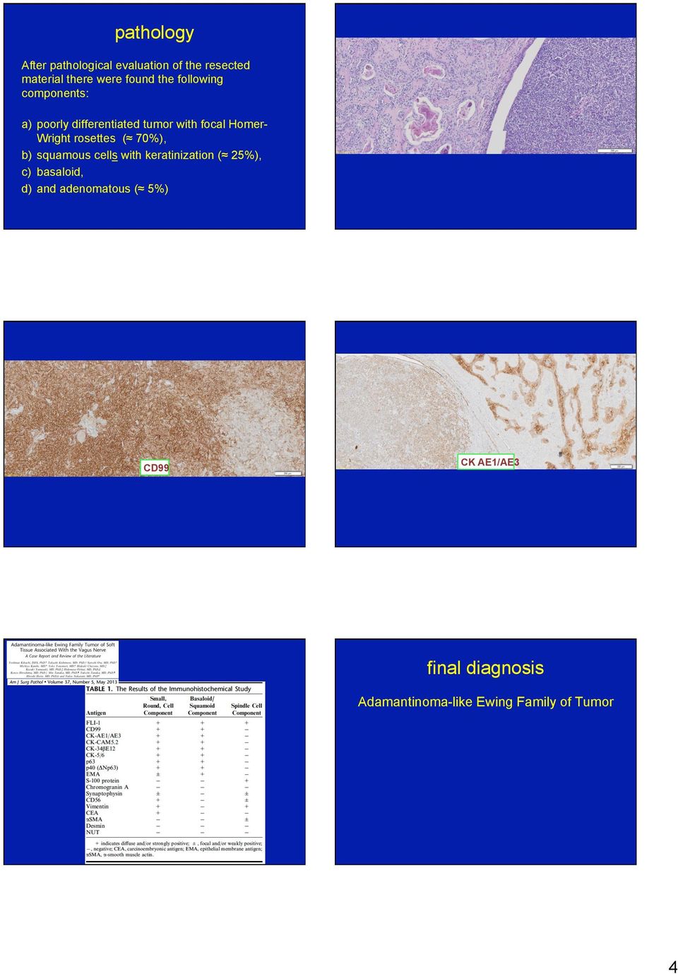 rosettes ( 70%), b) squamous cells with keratinization ( 25%), c) basaloid, d) and