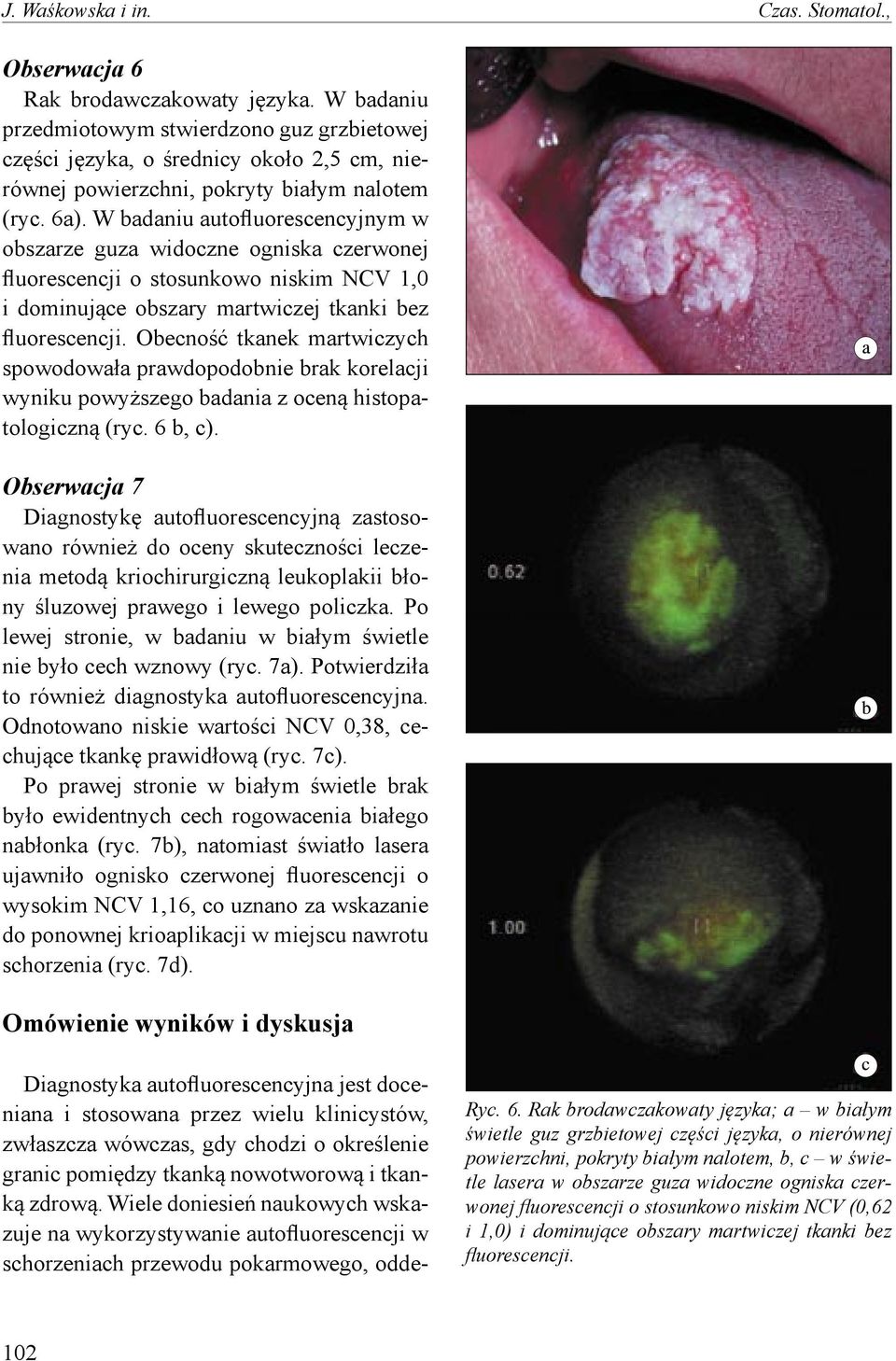W badaniu autofluorescencyjnym w obszarze guza widoczne ogniska czerwonej fluorescencji o stosunkowo niskim NCV 1,0 i dominujące obszary martwiczej tkanki bez fluorescencji.