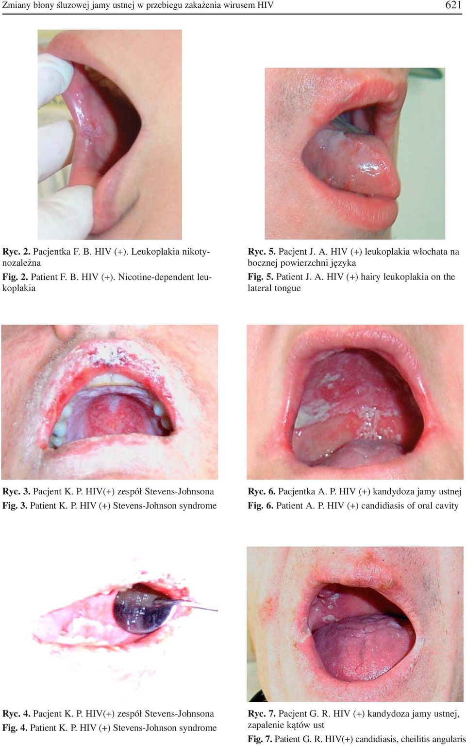 3. Patient K. P. HIV (+) Stevens Johnson syndrome Ryc. 6. Pacjentka A. P. HIV (+) kandydoza jamy ustnej Fig. 6. Patient A. P. HIV (+) candidiasis of oral cavity Ryc. 4. Pacjent K. P. HIV(+) zespół Stevens Johnsona Fig.