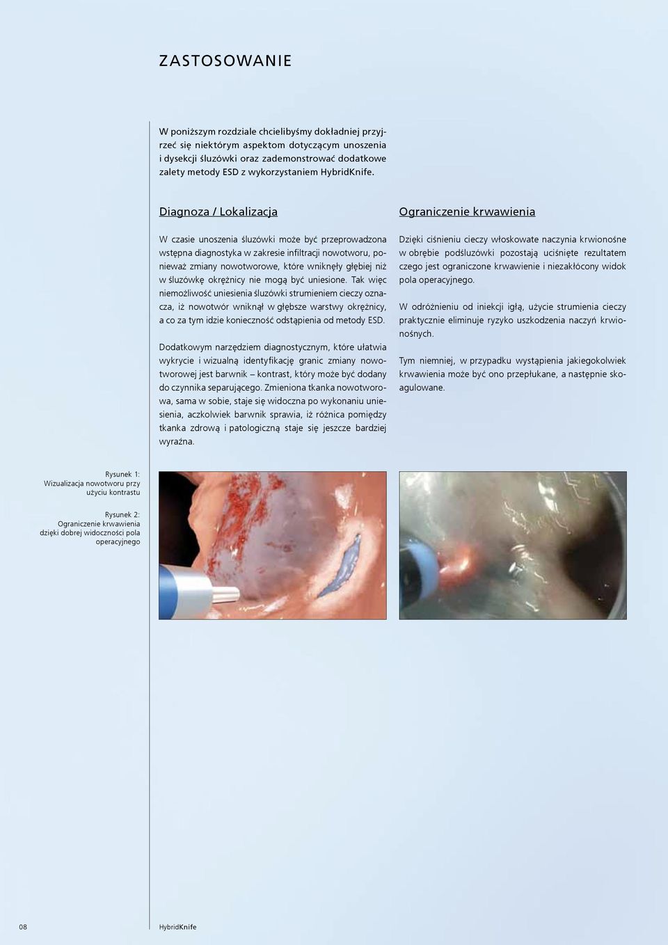 Diagnoza / Lokalizacja Ograniczenie krwawienia W czasie unoszenia śluzówki może być przeprowadzona wstępna diagnostyka w zakresie infiltracji nowotworu, ponieważ zmiany nowotworowe, które wniknęły