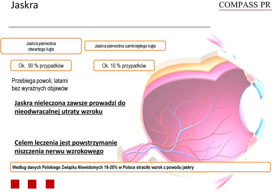 10 % przypadków Przebiega powoli, latami bez wyraźnych objawów Jaskra nieleczona zawsze