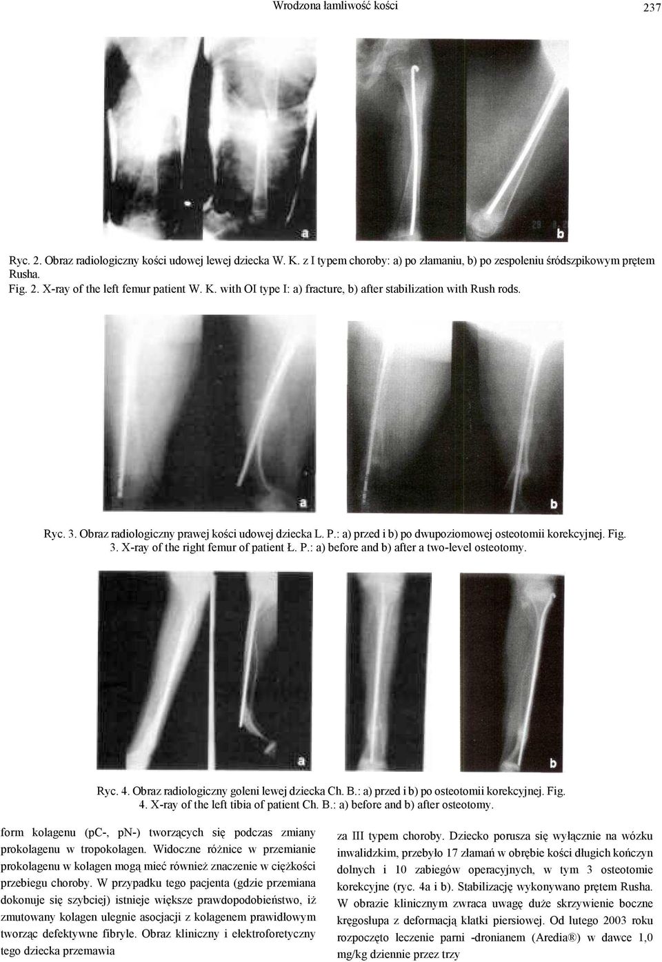 P.: a) before and b) after a two-level osteotomy. Ryc. 4. Obraz radiologiczny goleni lewej dziecka Ch. B.: a) przed i b) po osteotomii korekcyjnej. Fig. 4. X-ray of the left tibia of patient Ch. B.: a) before and b) after osteotomy.