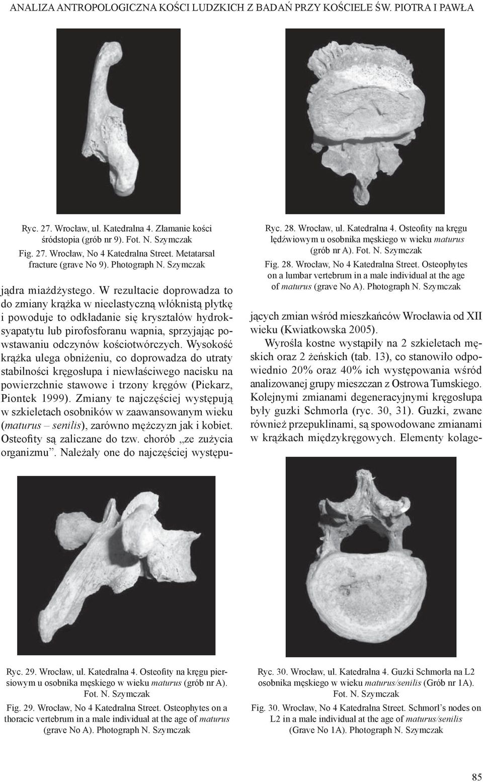 Osteophytes on a lumbar vertebrum in a male individual at the age of maturus (grave No A). Photograph N. Szymczak jądra miażdżystego.