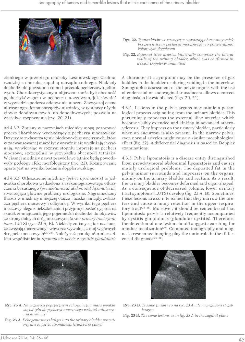 External iliac arteries bilaterally compress the lateral walls of the urinary bladder, which was confirmed in a color Doppler examination cienkiego w przebiegu choroby Leśniowskiego-Crohna, rzadziej