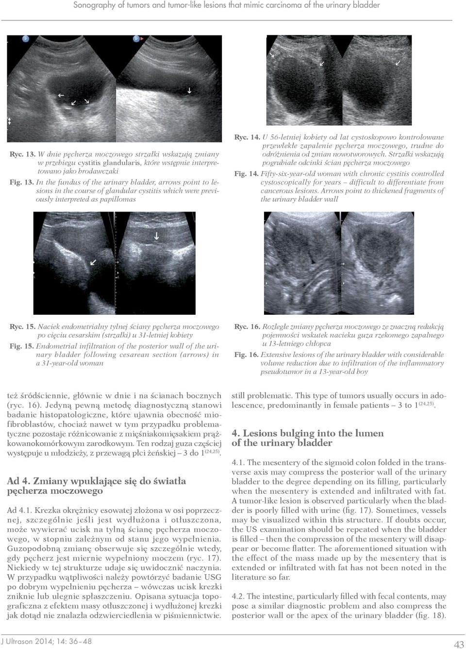 In the fundus of the urinary bladder, arrows point to lesions in the course of glandular cystitis which were previously interpreted as papillomas Ryc. 14.